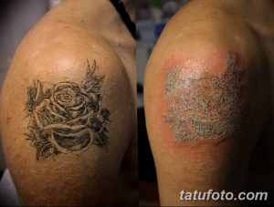 Фотография демонстрирует удаление татуировки с плеча. Слева - татуировка с изображением розы, справа - кожа после процедуры удаления.