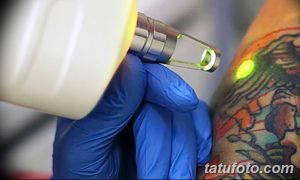 Фотография демонстрирует процесс лазерного удаления татуировки с руки. Виден луч лазера, направленный на татуировку с яркими цветами.