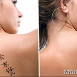 Фото удаление татуировки 21.11.2018 №104 - photo tattoo removal - tatufoto.com