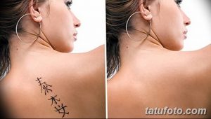 Фотография демонстрирует удаление татуировки с шеи. Слева - татуировка с иероглифами, справа - кожа после процедуры удаления.