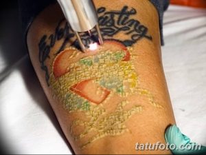 Фотография демонстрирует процесс лазерного удаления татуировки с руки. Виден луч лазера, направленный на татуировку с изображением сердца.