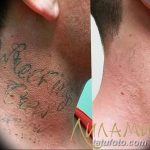 Фото удаление татуировки 21.11.2018 №108 - photo tattoo removal - tatufoto.com