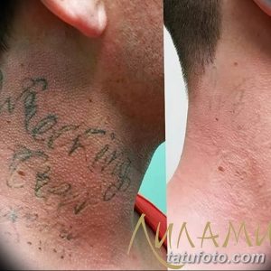Фотография демонстрирует удаление старой, выцветшей татуировки с шеи. Слева - размытый рисунок, справа - чистая кожа после процедуры.