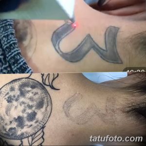 Фотография демонстрирует удаление татуировки с лица. Слева - татуировка в виде волн, справа - кожа после процедуры удаления.