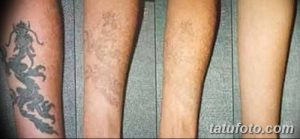 Фотография демонстрирует этапы удаления татуировки с голени. Видны изменения кожи от четкого рисунка до бледных следов и, наконец, чистой кожи.