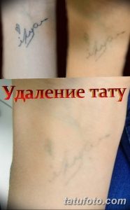 Фотография демонстрирует процесс удаления татуировки с надписью и изображением сердца на руке с помощью лазера. Видны следы от татуировки и процесс заживления кожи.