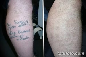 Фотография демонстрирует процесс удаления надписи татуировки на икре с помощью лазера. Видны следы от татуировки и процесс заживления кожи.