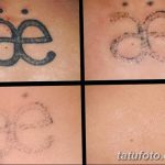 Фото удаление татуировки 21.11.2018 №114 - photo tattoo removal - tatufoto.com