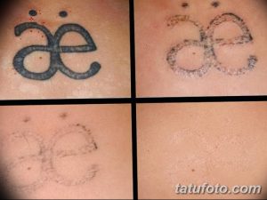 Фотография демонстрирует процесс удаления татуировки с изображением символов на спине с помощью лазера. Видны следы от татуировки и процесс заживления кожи.