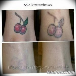 Фотография демонстрирует процесс удаления татуировки с изображением двух вишен на лодыжке с помощью лазера. Видны следы от татуировки и процесс заживления кожи.