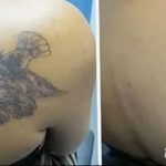 Фото удаление татуировки 21.11.2018 №116 - photo tattoo removal - tatufoto.com