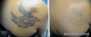 Фотография демонстрирует процесс удаления татуировки с изображением птицы на лопатке с помощью лазера. Видны следы от татуировки и процесс заживления кожи.