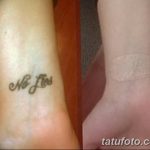 Фото удаление татуировки 21.11.2018 №117 - photo tattoo removal - tatufoto.com