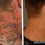 Фото удаление татуировки 21.11.2018 №120 - photo tattoo removal - tatufoto.com