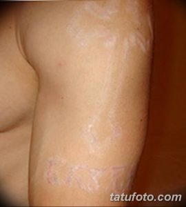 Фотография демонстрирует шрамы и рубцы на коже после неудачного удаления татуировки. Видны следы повреждений и неравномерное заживление.
