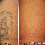 Фото удаление татуировки 21.11.2018 №123 - photo tattoo removal - tatufoto.com