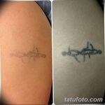 Фото удаление татуировки 21.11.2018 №124 - photo tattoo removal - tatufoto.com
