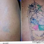 Фото удаление татуировки 21.11.2018 №125 - photo tattoo removal - tatufoto.com