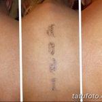 Фото удаление татуировки 21.11.2018 №126 - photo tattoo removal - tatufoto.com