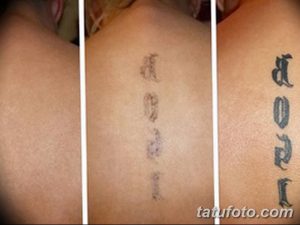 Фото удаление татуировки 21.11.2018 №126 - photo tattoo removal - tatufoto.com