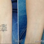 Фото удаление татуировки 21.11.2018 №127 - photo tattoo removal - tatufoto.com