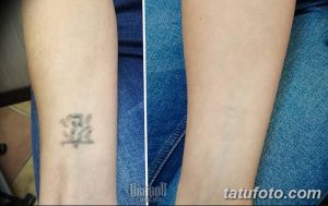 Фото удаление татуировки 21.11.2018 №127 - photo tattoo removal - tatufoto.com
