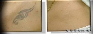 Фото удаление татуировки 21.11.2018 №128 - photo tattoo removal - tatufoto.com