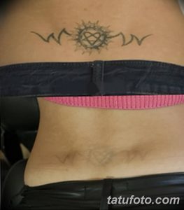 Фото удаление татуировки 21.11.2018 №129 - photo tattoo removal - tatufoto.com