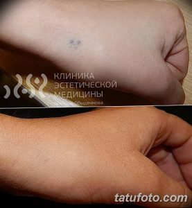 Фото удаление татуировки 21.11.2018 №130 - photo tattoo removal - tatufoto.com