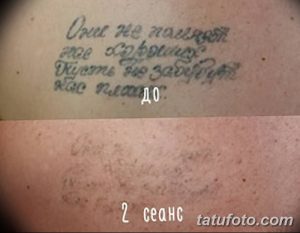 Фото удаление татуировки 21.11.2018 №131 - photo tattoo removal - tatufoto.com