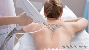 Фото процесса удаления татуировки лазером на спине женщины. Виден аппарат для удаления тату и кожа пациентки.