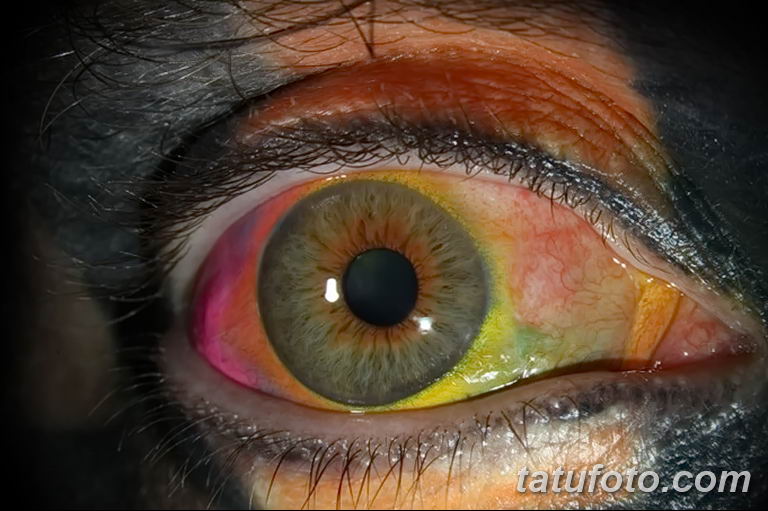 Разноцветные глазные яблоки – опыт (история) Мэтта Гоне - фото 1