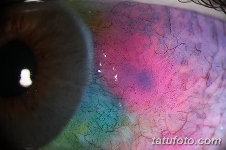 Разноцветные глазные яблоки – опыт (история) Мэтта Гоне - фото 5