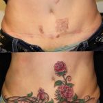 фото тату на шраме 29.04.2019 №023 - scar tattoo - tatufoto.com