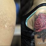 фото тату на шраме 29.04.2019 №053 - scar tattoo - tatufoto.com