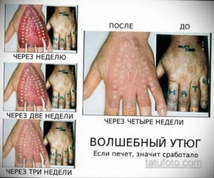 Фотография руки с поврежденной кожей после неудачной попытки удаления татуировки с помощью утюга. Ироничное изображение, демонстрирующее опасные методы.