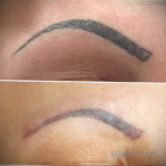 удаление перманентного макияжа 24.10.2019 №004 -permanent makeup- tatufoto.com