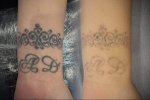 Фотография сравнения татуировки на запястье до и после нескольких сеансов лазерного удаления. Видно значительное осветление и размытие рисунка.