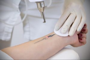 Фото процесса удаления небольшой татуировки в виде символа с помощью лазера, демонстрирующее точность и аккуратность процедуры.