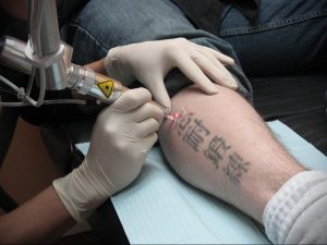 Фото процесса удаления татуировки с японскими иероглифами с помощью лазера, демонстрирующее работу мастера и используемое оборудование.