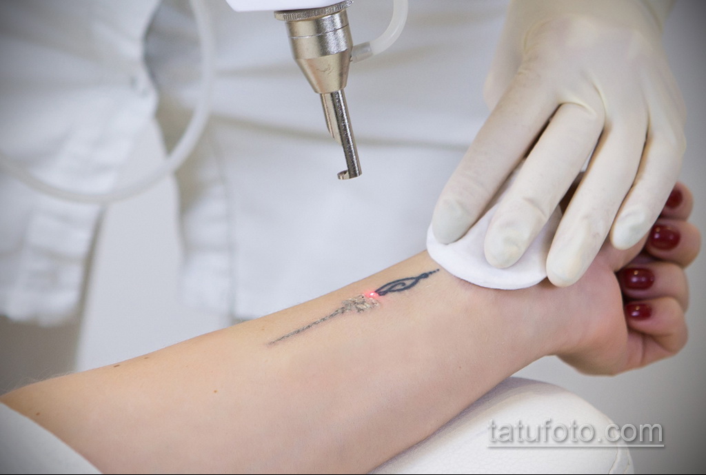 Фото пример удаления татуировки 31.05.2020 №001 - tattoo- tatufoto.com