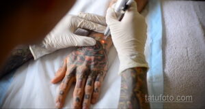 Фото тату процесса удаления татуировки лазером на руке. Виден луч лазера, воздействующий на татуировку, покрывающую всю кисть.
