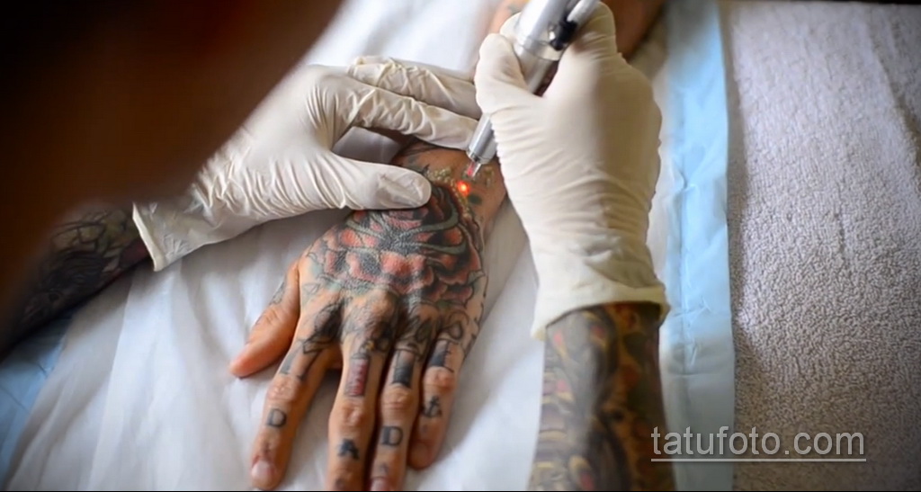 Фото пример удаления татуировки 31.05.2020 №004 - tattoo- tatufoto.com