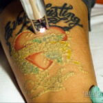 Фото пример удаления татуировки 31.05.2020 №006 - tattoo- tatufoto.com