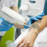 Фото пример удаления татуировки 31.05.2020 №009 - tattoo- tatufoto.com