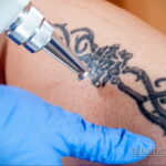 Фото пример удаления татуировки 31.05.2020 №010 - tattoo- tatufoto.com