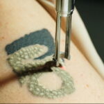 Фото пример удаления татуировки 31.05.2020 №012 - tattoo- tatufoto.com
