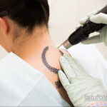 Фото пример удаления татуировки 31.05.2020 №016 - tattoo- tatufoto.com