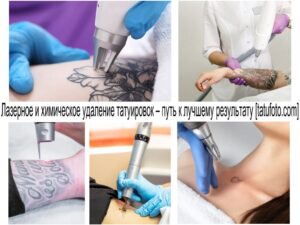 Коллаж из фотографий, демонстрирующих процесс лазерного и химического удаления татуировок. Видны аппараты, руки мастеров и участки кожи с татуировками.
