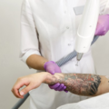 удаление тату лазером - laser tattoo removal - 25012021 - фото 1